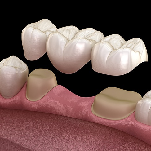 Illustration of dental bridge being attached to natural teeth