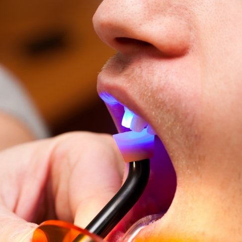 Close up of dental patient receiving cosmetic bonding on front upper tooth