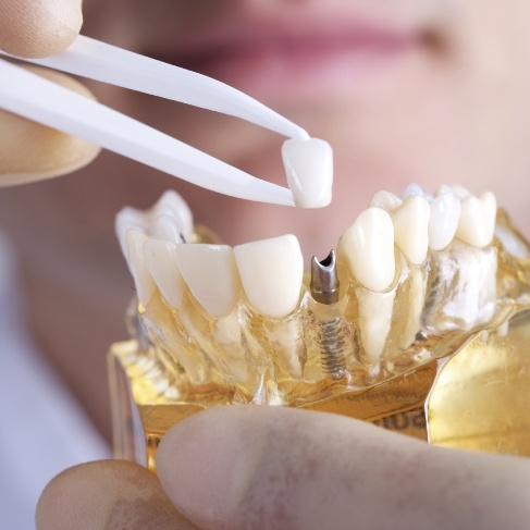 Dentist placing a dental crown on a model of dental implants in Louisville