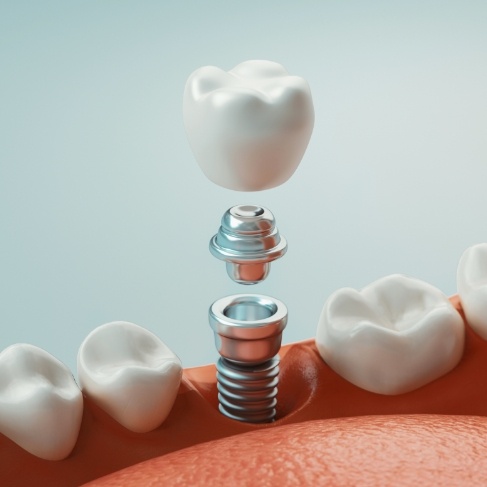 Illustrated dental implant and crown being placed in the lower jaw