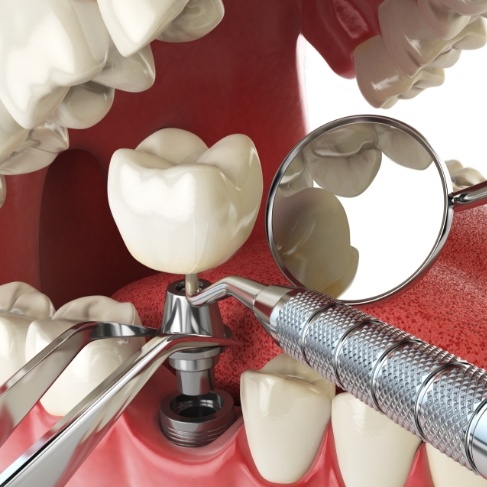 Illustrated model of how dental implants work