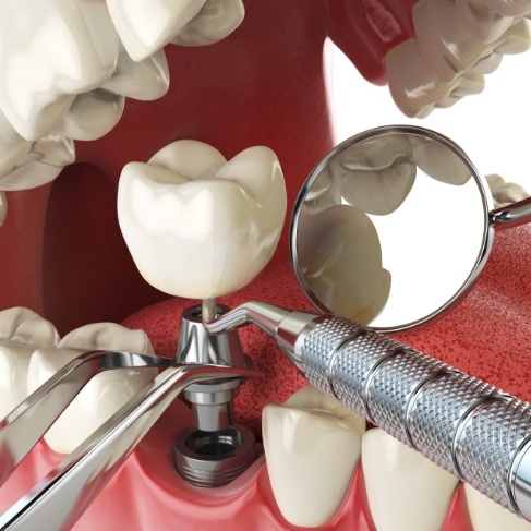 Illustrated model of how dental implants work