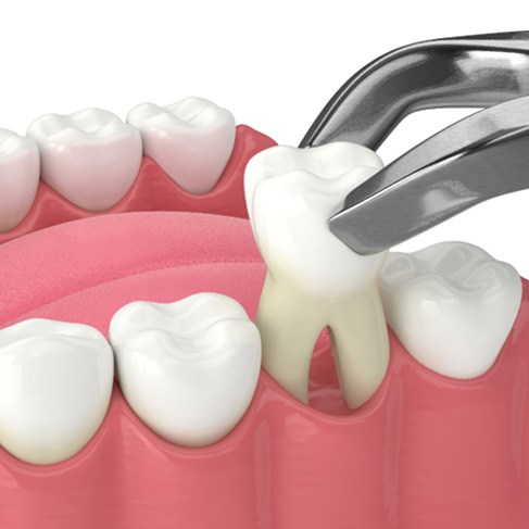 Illustration of a tooth being extracted