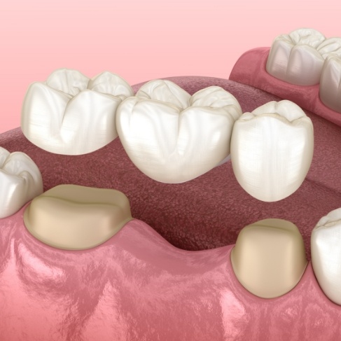 Illustrated dental bridge replacing a missing tooth