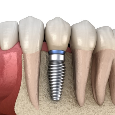 Illustrated dental implant replacing a missing tooth