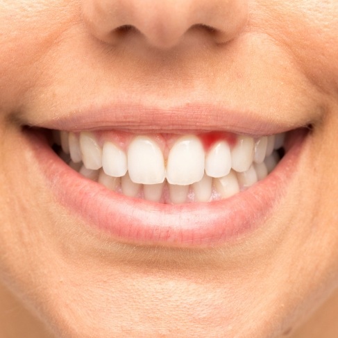 Close up of smile with red spot in gums