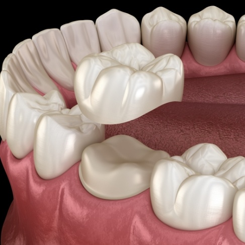 Illustrated dental crown being placed over a tooth