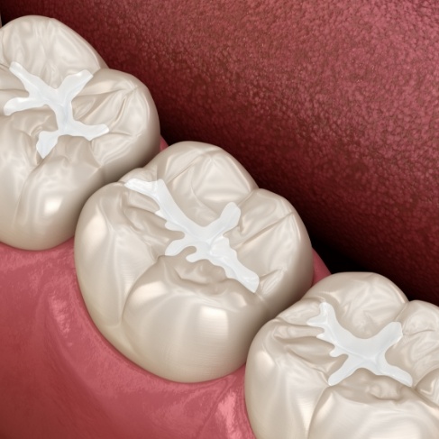 Illustrated row of teeth with white fillings