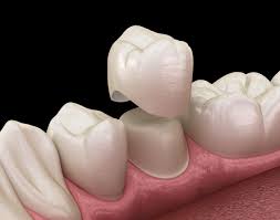 Dental Bridge