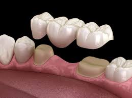 Dental Bridge -hurstbournedentalcare.com