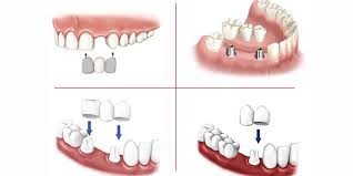 dental bridges