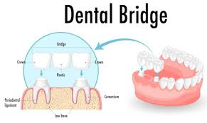 Dental Bridge