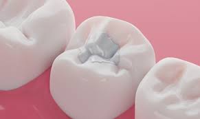 Have a Cavity or Broken Tooth