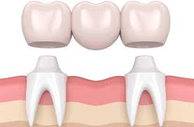 Dental Crown