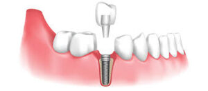 Dental Bridges