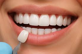 dental veneers
