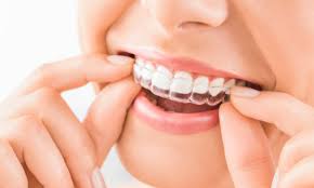 clear dental aligner