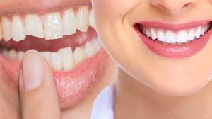 repair chipped or broken teeth