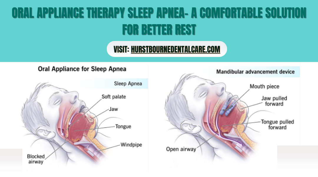 Oral Appliance Therapy Sleep Apnea